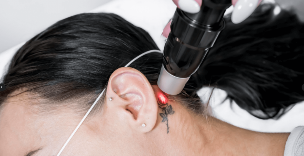 Get Rid of Unwanted Ink with Laser Tattoo Removal