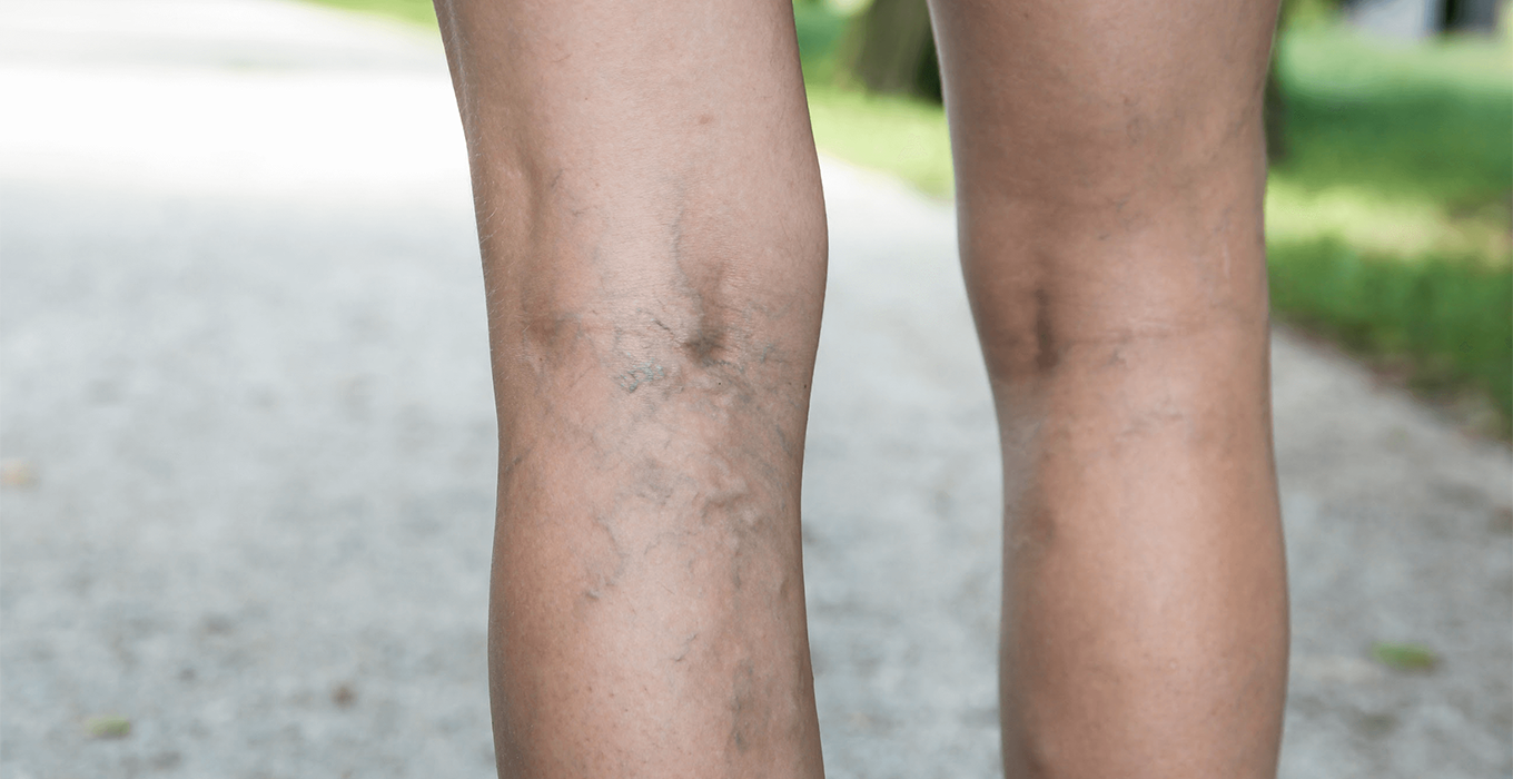 Clear Vein Laser Treatment